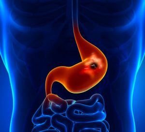 gastrit